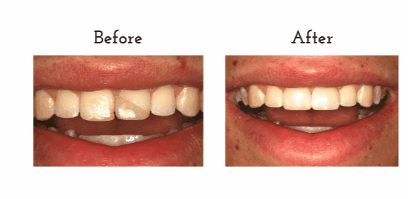 Before and After cosmetic bonding