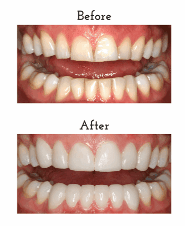 Before and after porcelain veneers