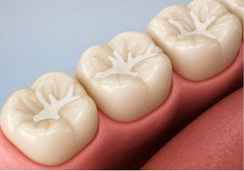 Dental sealants applied to molars to help protect teeth from cavities and tooth decay.