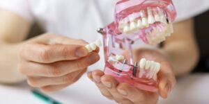 denture implant