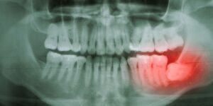 X-ray showing an impacted wisdom tooth in the lower jaw.