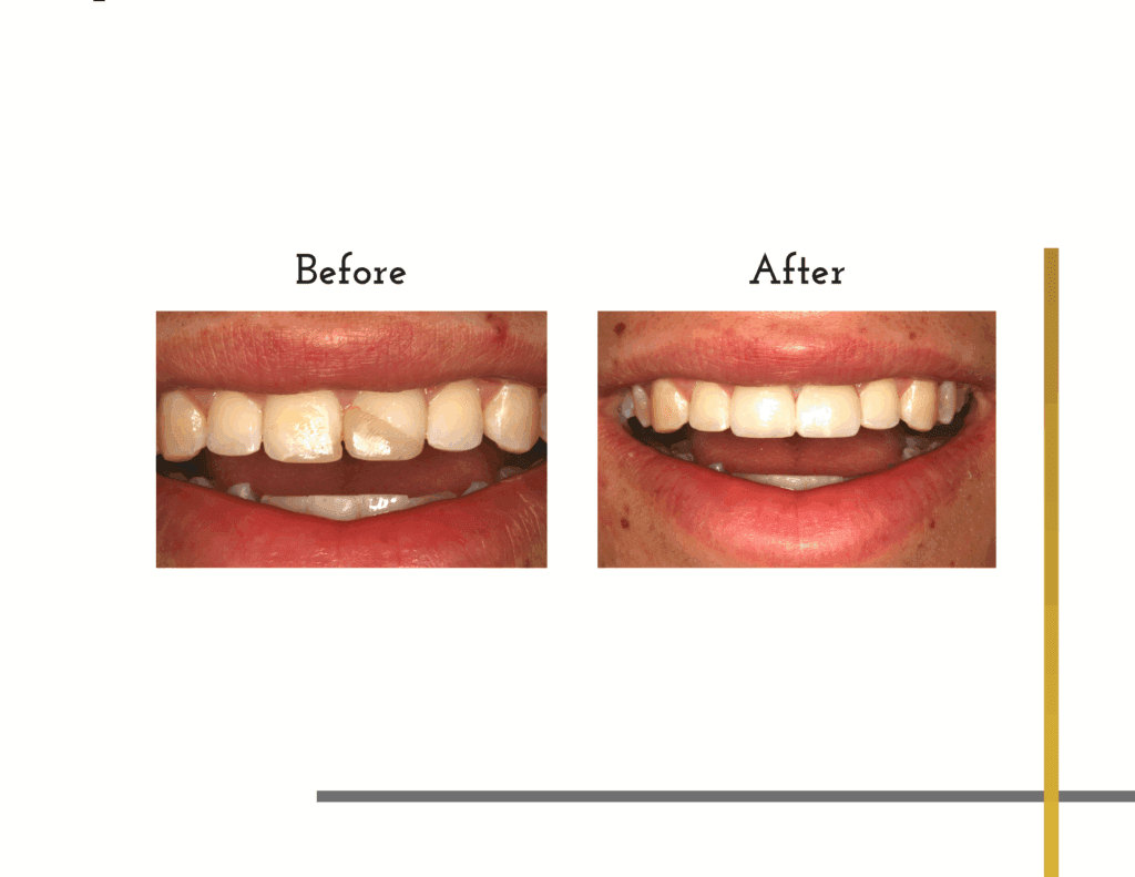 Before and after dental appointment for porcelain veneers