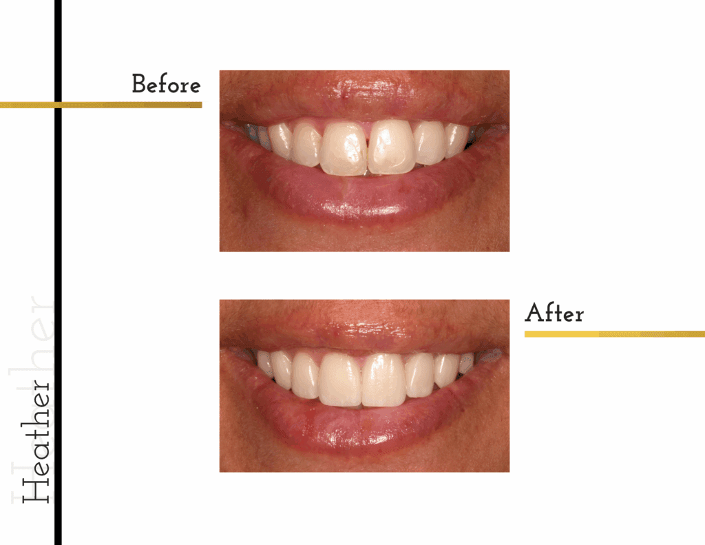 Before and after porcelain veneers of Heather
