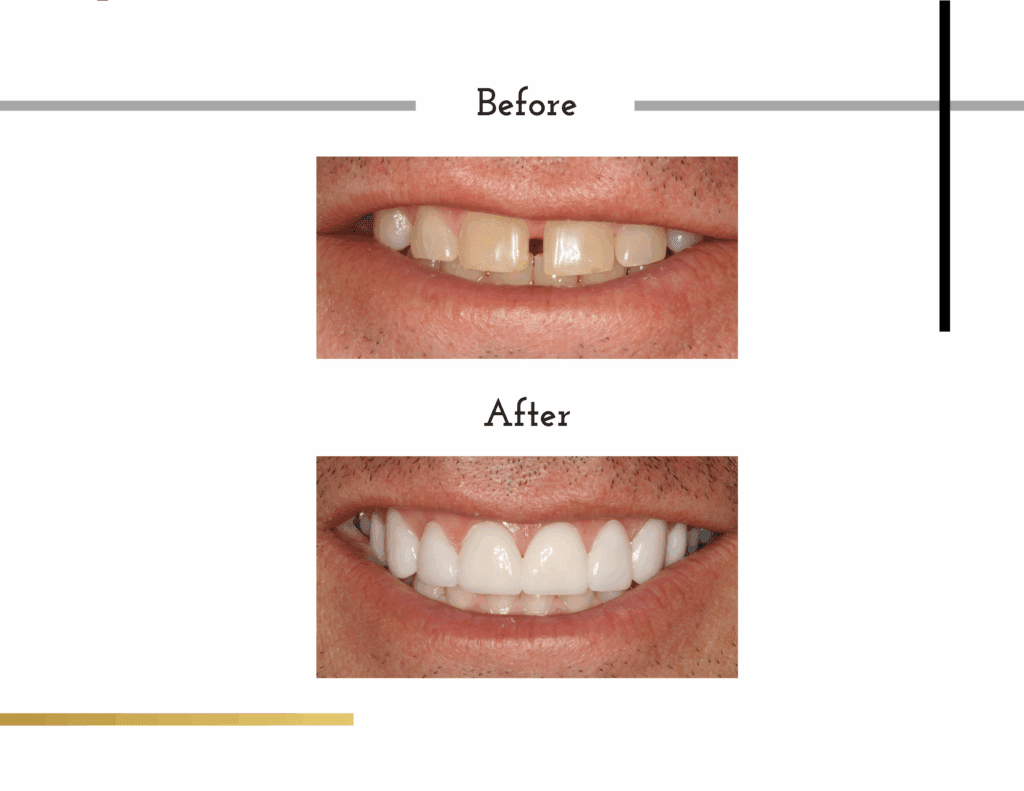 Before and after porcelain veneers of Jerry