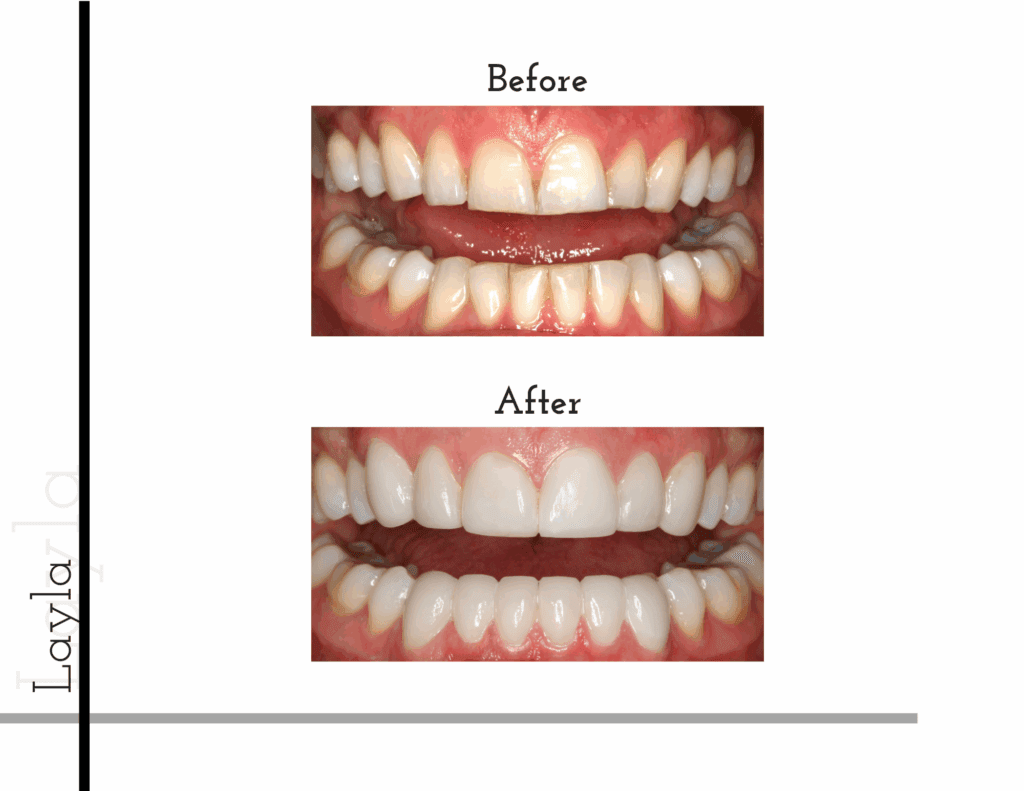 Before and after porcelain veneers of Layla