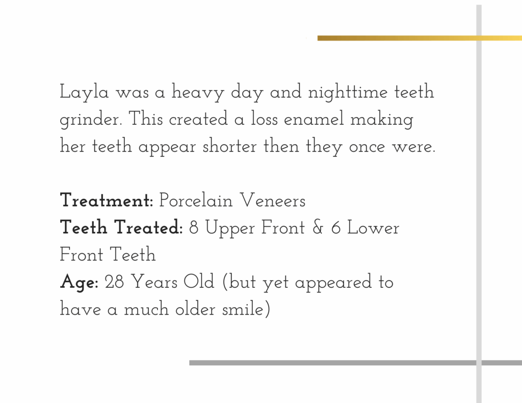 Details about porcelain veneer patient named Layla