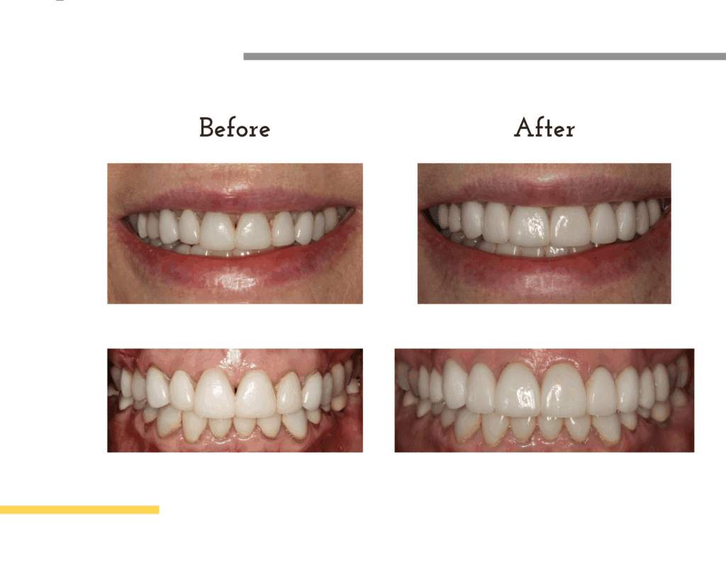 Before and after porcelain veneers of Lacey