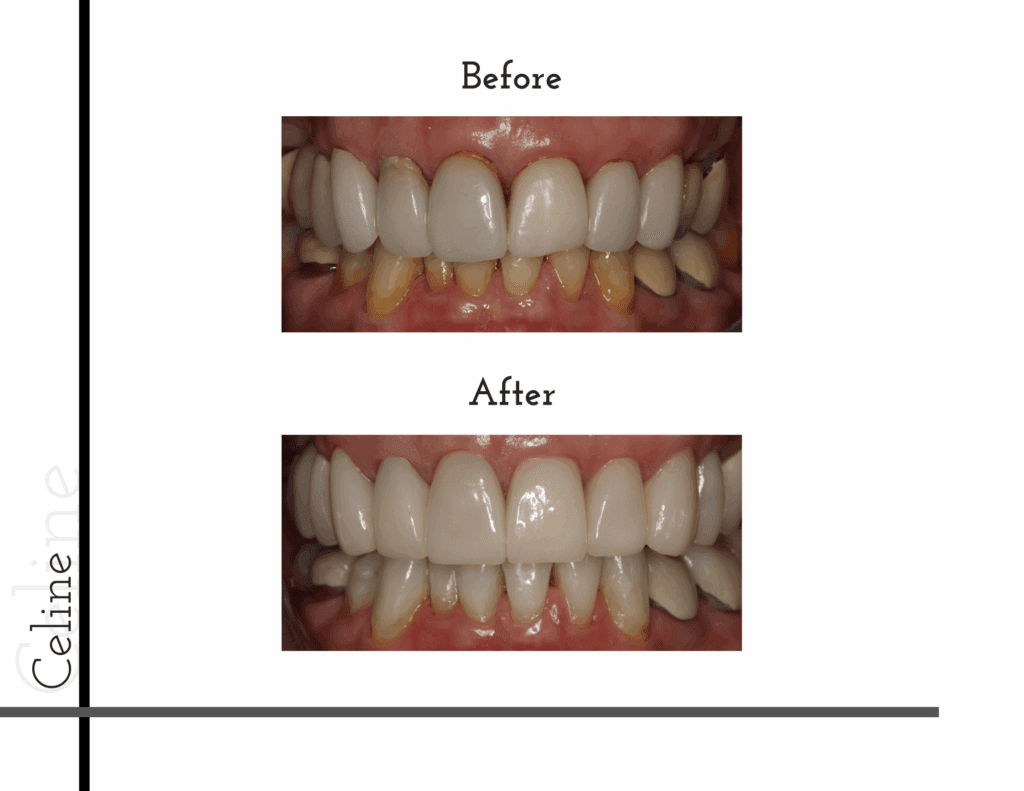 Before and after porcelain crowns of Celine