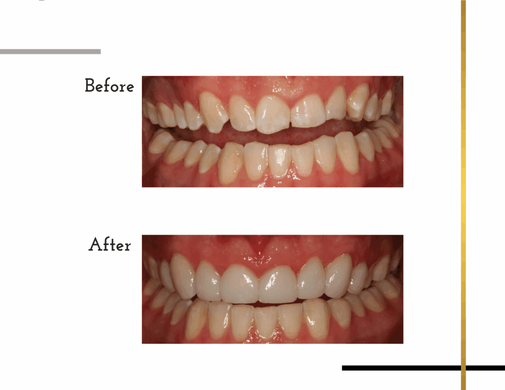 Before and after porcelain crowns transformation for patient Dylan