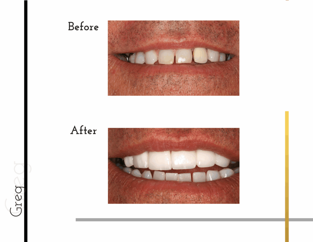 Before and after porcelain crowns transformation for patient Greg