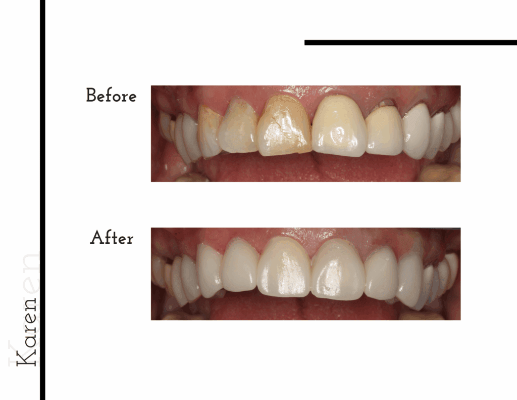 Before and after porcelain crowns transformation for patient Karen