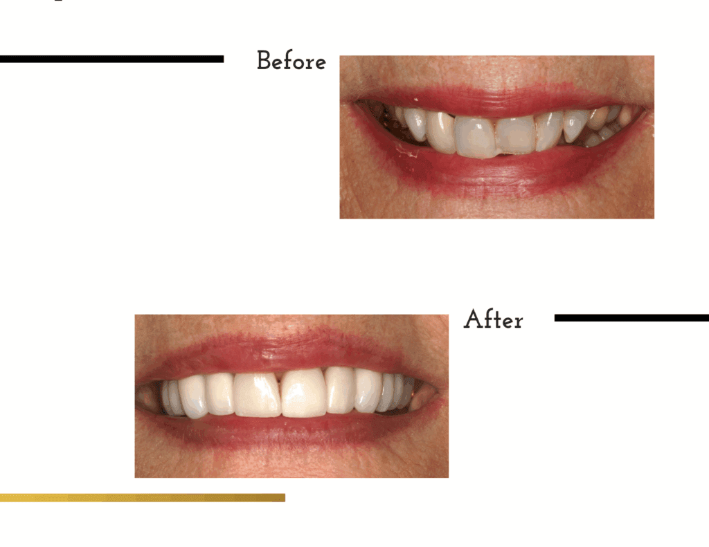 Before and after porcelain crowns transformation for patient Melody