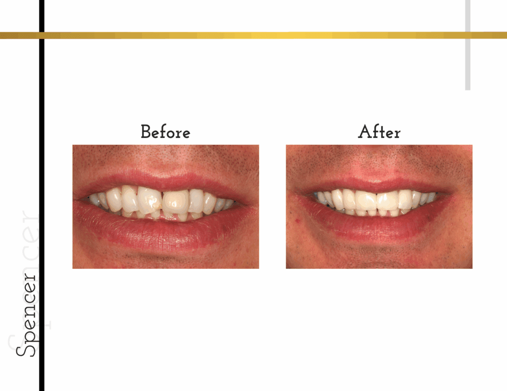 Before and after porcelain crowns transformation for patient Spencer
