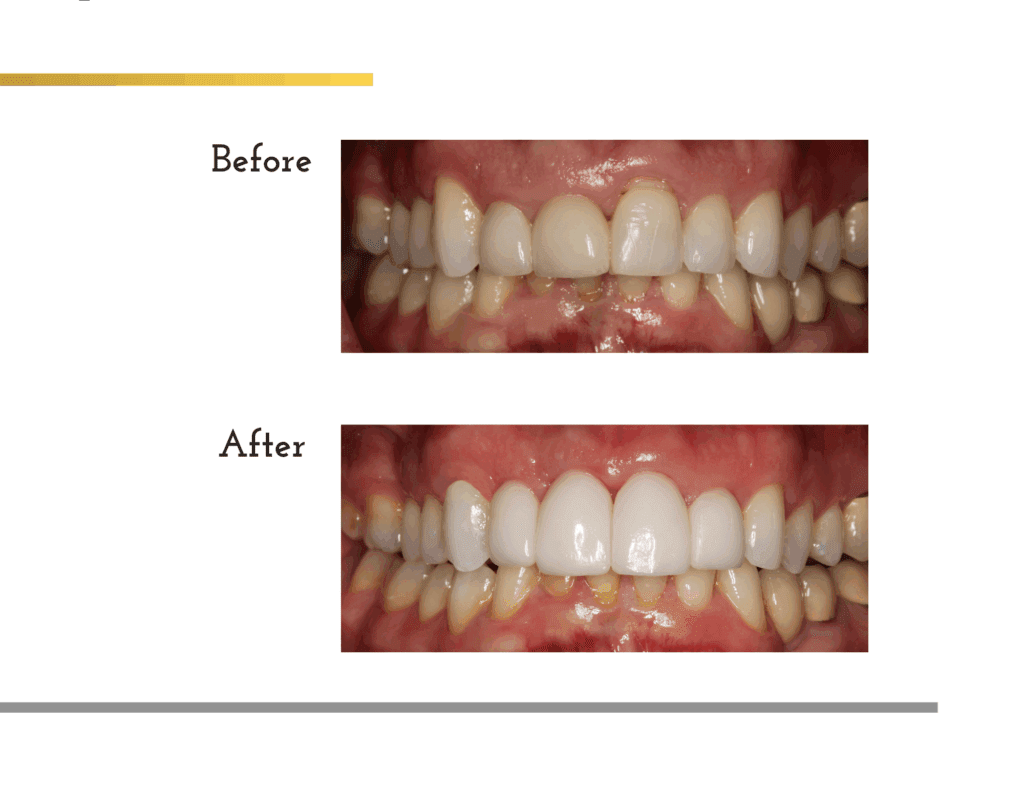 Before and after porcelain crowns transformation for patient Sam