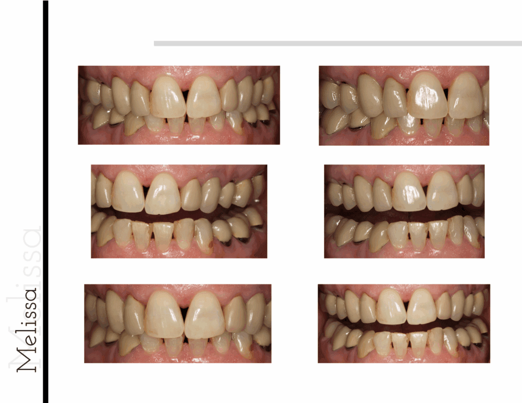 Before and after porcelain crowns transformation for patient Melanie