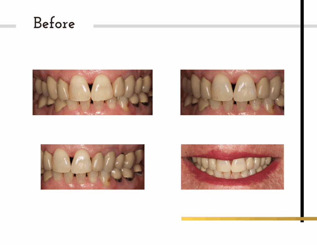 Before and after porcelain crowns transformation for patient Melanie