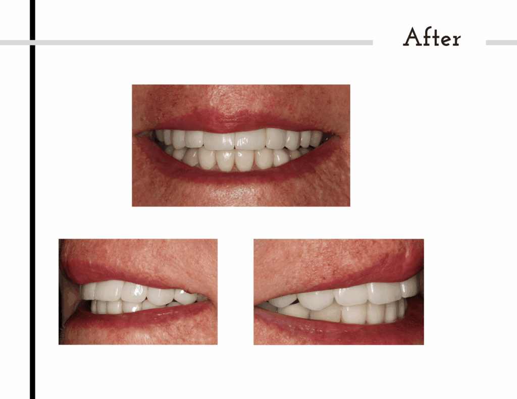 Before and after porcelain crowns transformation for patient Melanie