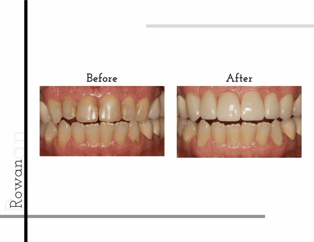 Before and after porcelain crowns transformation