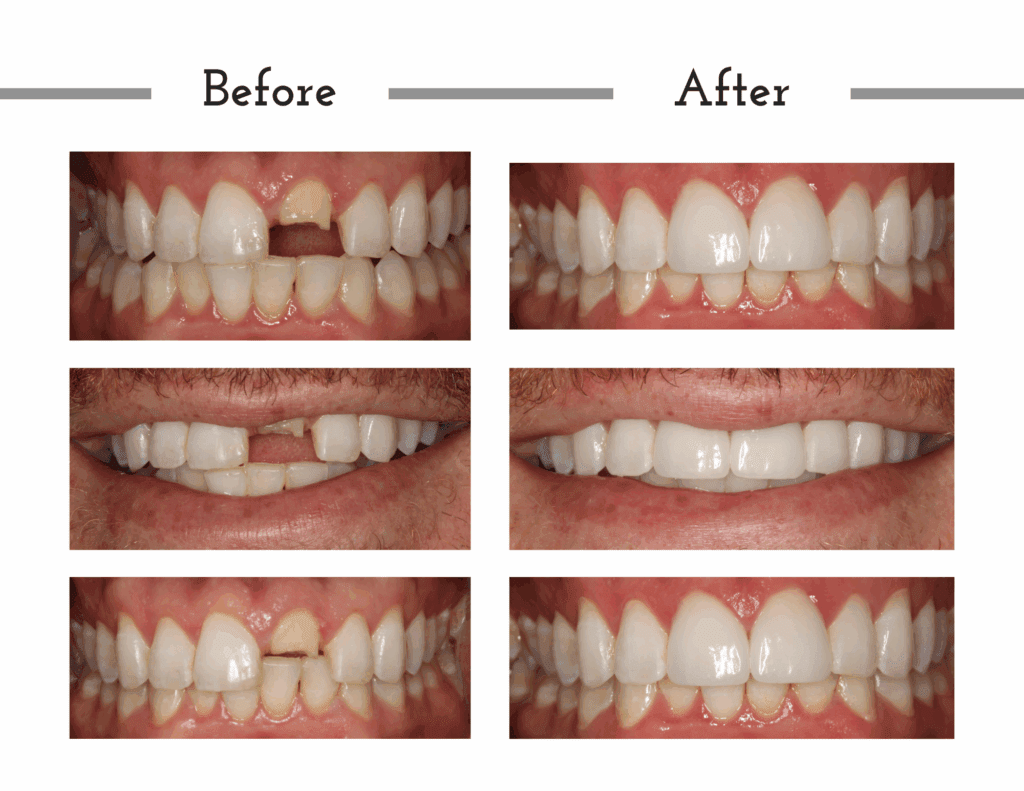 Before and after porcelain crowns transformation for patient Aiden