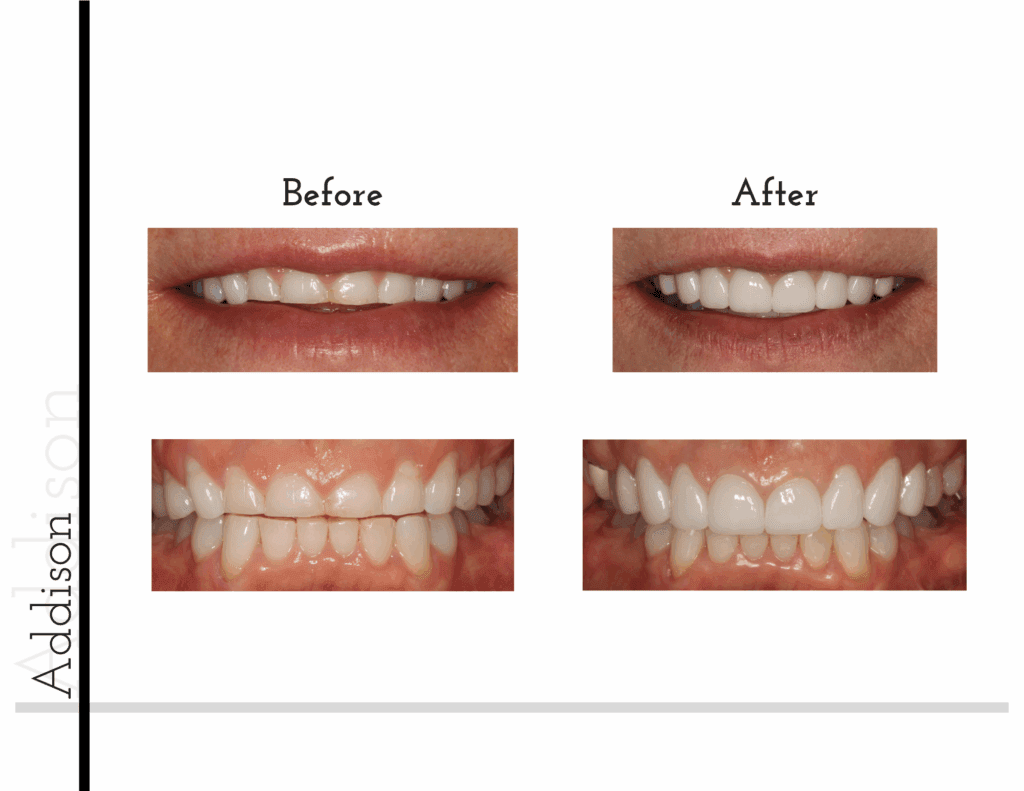 Before and after porcelain crowns transformation for patient Maddison