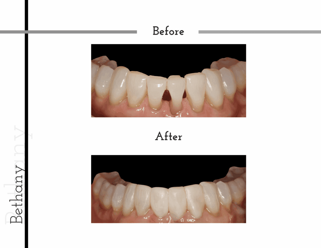 Before and after composite resin bonding transformation