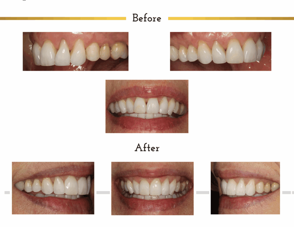 Before and after composite resin bonding transformation