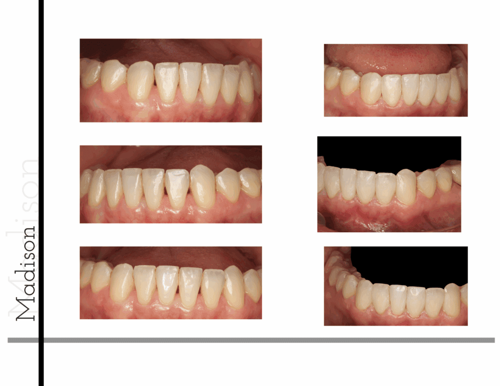 Before and after composite resin bonding transformation
