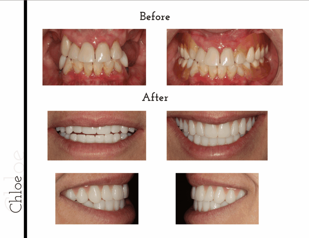 Before and after decoyed teeth transformation