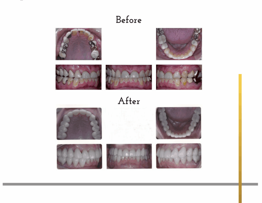 Before and after teeth transformation