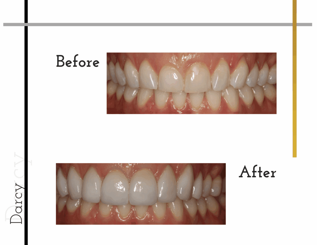 Before and after porcelain veneers