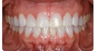 After Invisalign treatment