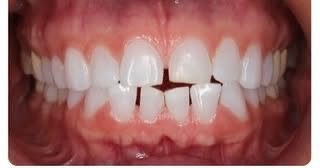 Before Invisalign treatment