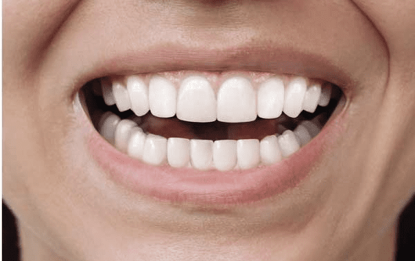 After Invisalign treatment