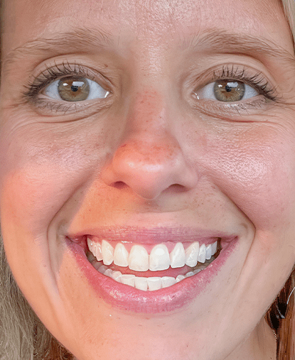 After Invisalign treatment