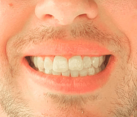 After Invisalign treatment