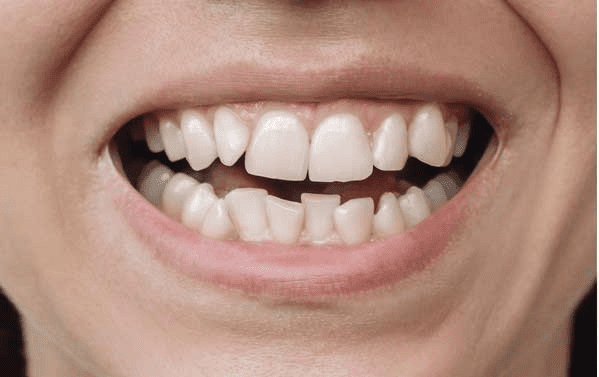 Before Invisalign treatment