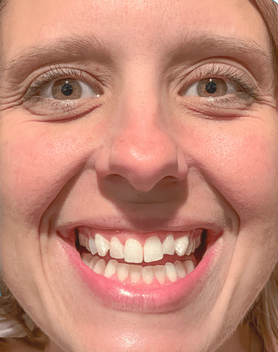 Before Invisalign treatment
