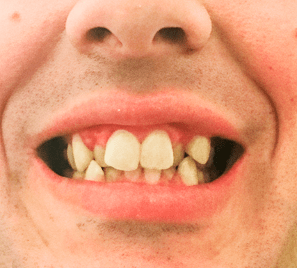 Before Invisalign treatment