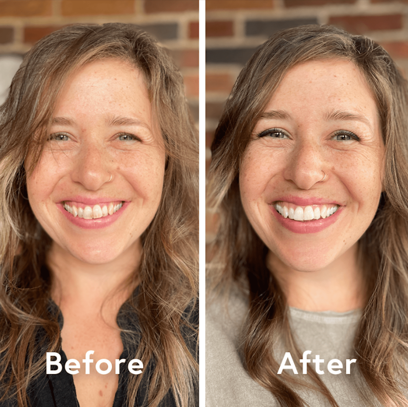 Before and after professional teeth whitening results showing a brighter, whiter smile transformation for a female dental patient.