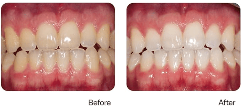 Before and after opalescence treatment