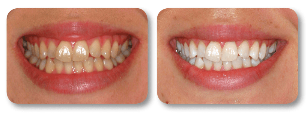 Before and after KoR whitening treatment